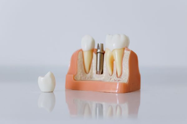 Extraction, greffe, implant : ce qu'on ne vous dit pas avant l'intervention